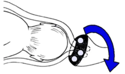 obsteric pessary