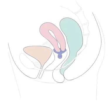 fungiform pessary