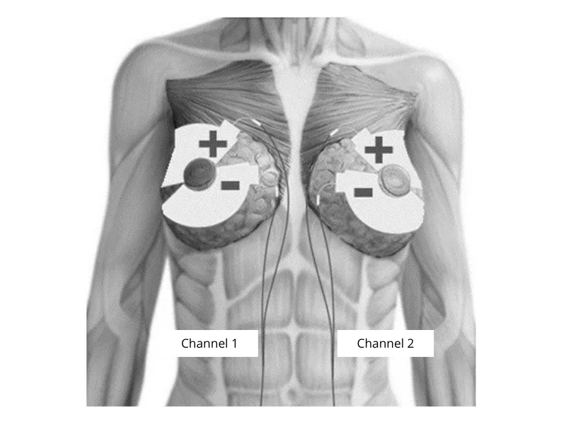 breast electrode